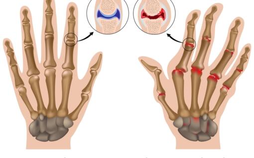 hands with arthritis